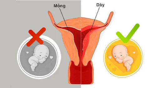 Niêm mạc tử cung mỏng sẽ ảnh hưởng đến khả năng bám vào làm tổ của phôi thai